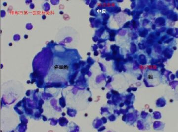 日本的一病例，看看有癌细胞吗？公布答案(来自日本资料)图1