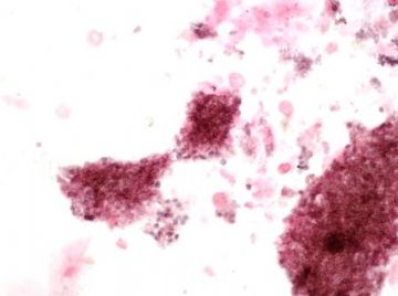 Pneumocystis Carinii Pneumonia--PCR图2