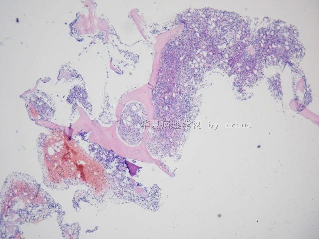 骨髓活检－432446图1
