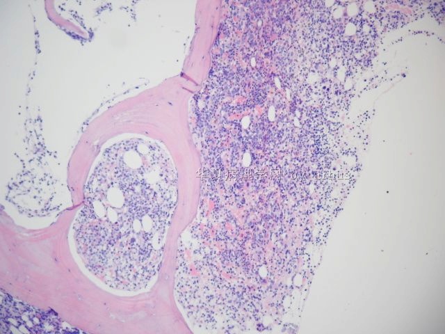 骨髓活检－432446图3