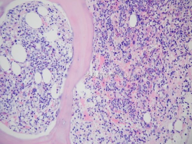 骨髓活检－432446图5