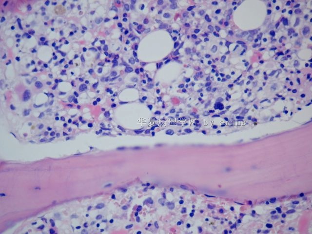骨髓活检－432446图11