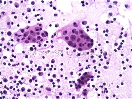 Cervical lymphadenopathy图2