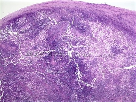 Cervical lymphadenopathy图4