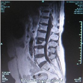 腰椎病理性骨折图1