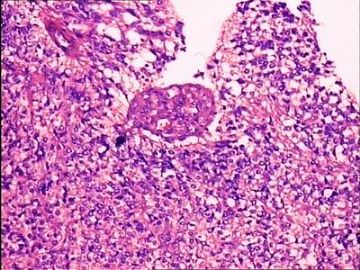 脑复发肿瘤-曾在北京知名医院诊断为间变性少突胶质细胞瘤图6