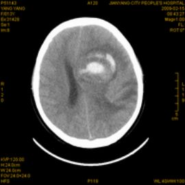 左颞顶额叶肿瘤（090843）图10