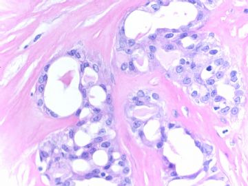Rare 乳腺分泌型癌 (cqz 13)图9