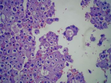 胸水细胞块图4