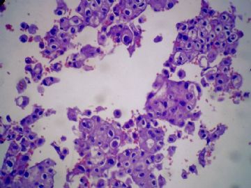 胸水细胞块图5