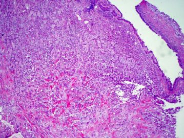 60 year old woman with tracheal mass图1