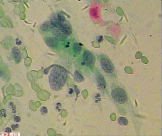 58岁，传统刮片，临床情况不清。图4
