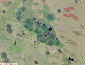 58岁，传统刮片，临床情况不清。图5