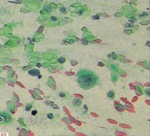 58岁，传统刮片，临床情况不清。图7