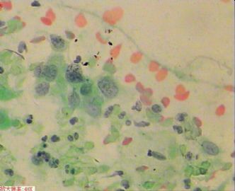 58岁，传统刮片，临床情况不清。图8