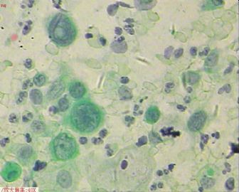 58岁，传统刮片，临床情况不清。图9