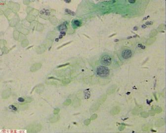 58岁，传统刮片，临床情况不清。图10