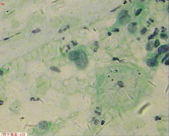 58岁，传统刮片，临床情况不清。图11
