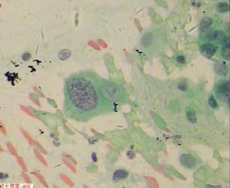 58岁，传统刮片，临床情况不清。图12