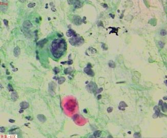 58岁，传统刮片，临床情况不清。图14