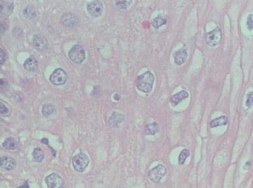 [求助]大家看看这些细胞是不是挖空细胞，是糖原溶解还是哪种感染啊 ？？图4