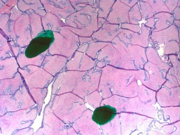 Breast fibroepithelial lesions (cqz 15)图1