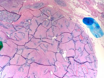 Breast fibroepithelial lesions (cqz 15)图2