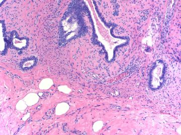 Breast fibroepithelial lesions (cqz 15)图5