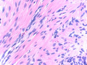 Breast fibroepithelial lesions (cqz 15)图6