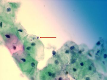 candida species,yeast forms and pseudohyphe.图1