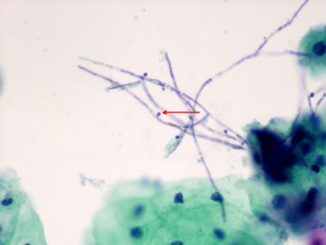 candida species,yeast forms and pseudohyphe.图2