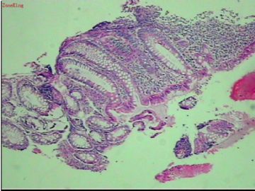 直肠粘膜活检,是不是恶性病变?图3