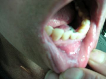 下颌牙龈下肿瘤，请帮忙诊断。图1