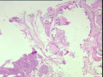 求诊断结果：肠系膜淋巴结表面灰色结节，0.5*0.5cm,质硬图2