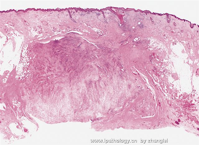 软组织病理学习笔记（二）纤维母细胞和肌纤维母细胞肿瘤图3