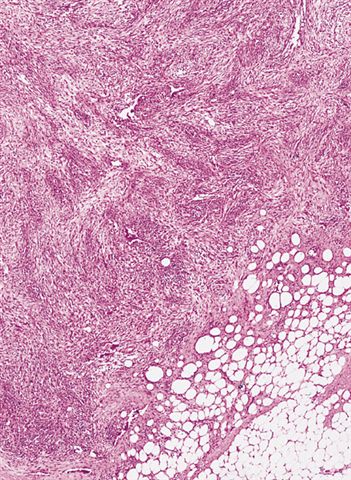 软组织病理学习笔记（二）纤维母细胞和肌纤维母细胞肿瘤图4
