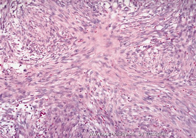 软组织病理学习笔记（二）纤维母细胞和肌纤维母细胞肿瘤图6