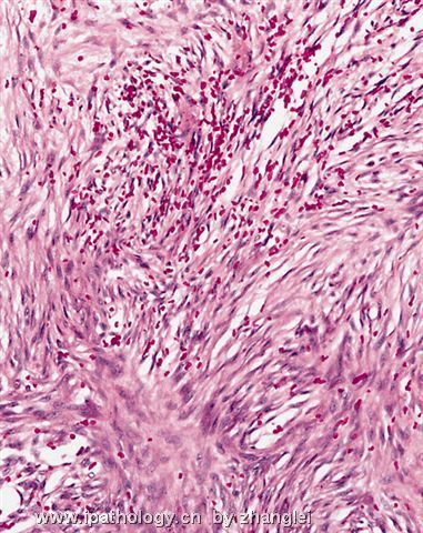 软组织病理学习笔记（二）纤维母细胞和肌纤维母细胞肿瘤图7