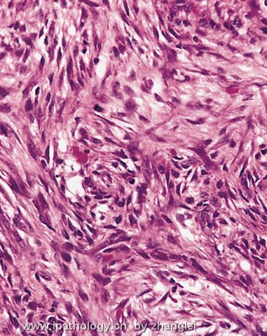 软组织病理学习笔记（二）纤维母细胞和肌纤维母细胞肿瘤图8