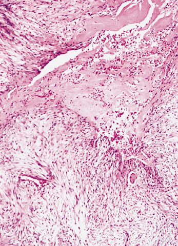 软组织病理学习笔记（二）纤维母细胞和肌纤维母细胞肿瘤图11