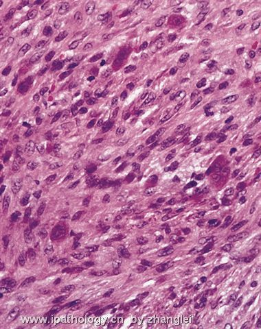 软组织病理学习笔记（二）纤维母细胞和肌纤维母细胞肿瘤图12