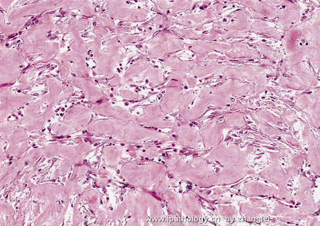 软组织病理学习笔记（二）纤维母细胞和肌纤维母细胞肿瘤图13