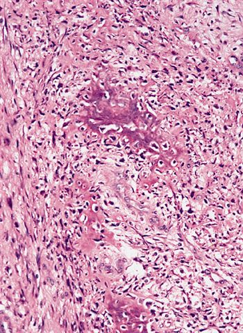 软组织病理学习笔记（二）纤维母细胞和肌纤维母细胞肿瘤图15
