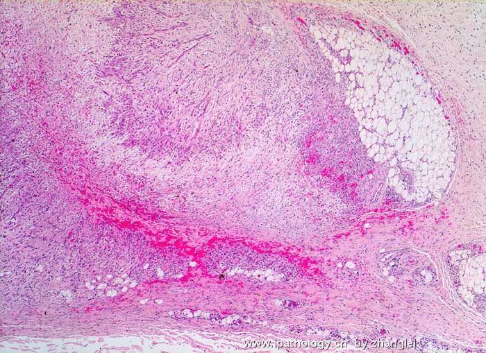 软组织病理学习笔记（二）纤维母细胞和肌纤维母细胞肿瘤图16