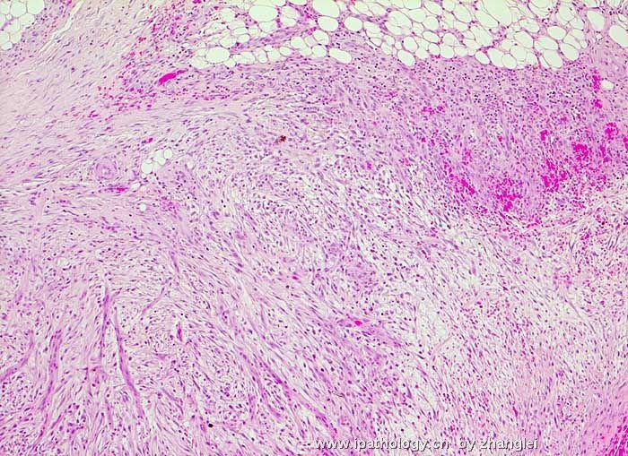 软组织病理学习笔记（二）纤维母细胞和肌纤维母细胞肿瘤图18