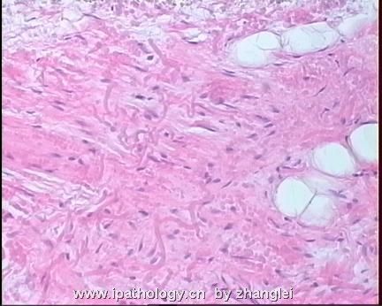 软组织病理学习笔记（二）纤维母细胞和肌纤维母细胞肿瘤图19