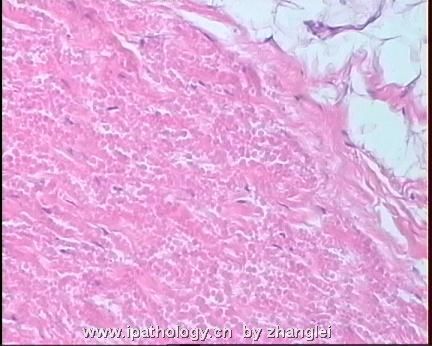 软组织病理学习笔记（二）纤维母细胞和肌纤维母细胞肿瘤图20