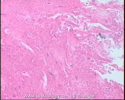 软组织病理学习笔记（二）纤维母细胞和肌纤维母细胞肿瘤图21