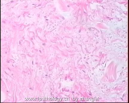 软组织病理学习笔记（二）纤维母细胞和肌纤维母细胞肿瘤图22
