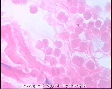 软组织病理学习笔记（二）纤维母细胞和肌纤维母细胞肿瘤图24